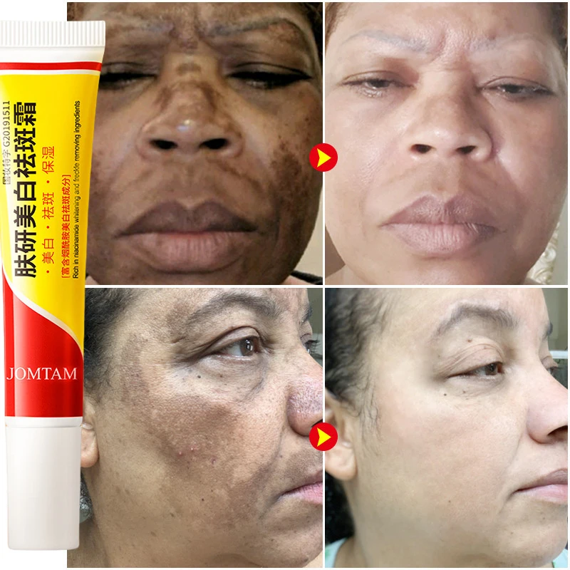 Creme clareador de sardas, cre - Skincare Glad2Glow avaliação e preço